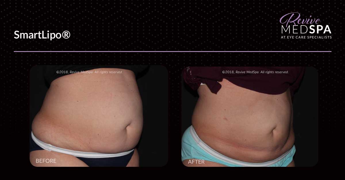 SmartLipo Before and After