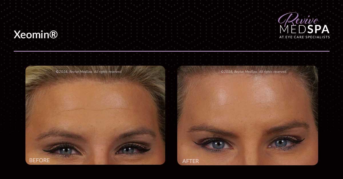 Xeomin Before and After