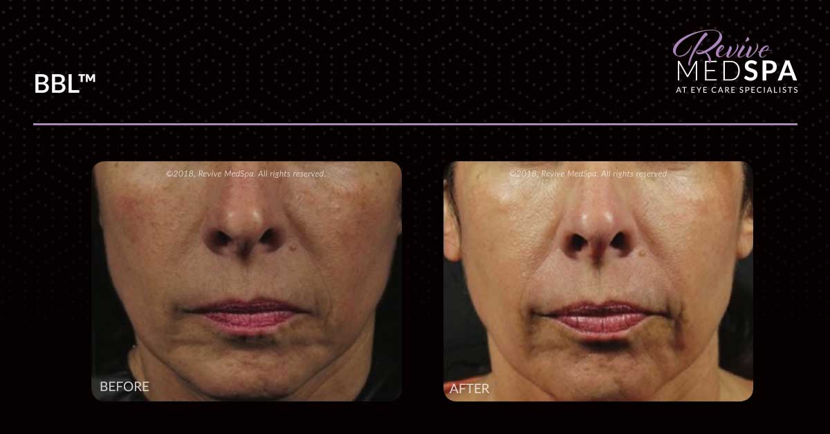 Scranton Facial Rejuvenation - Porno Photo-4823