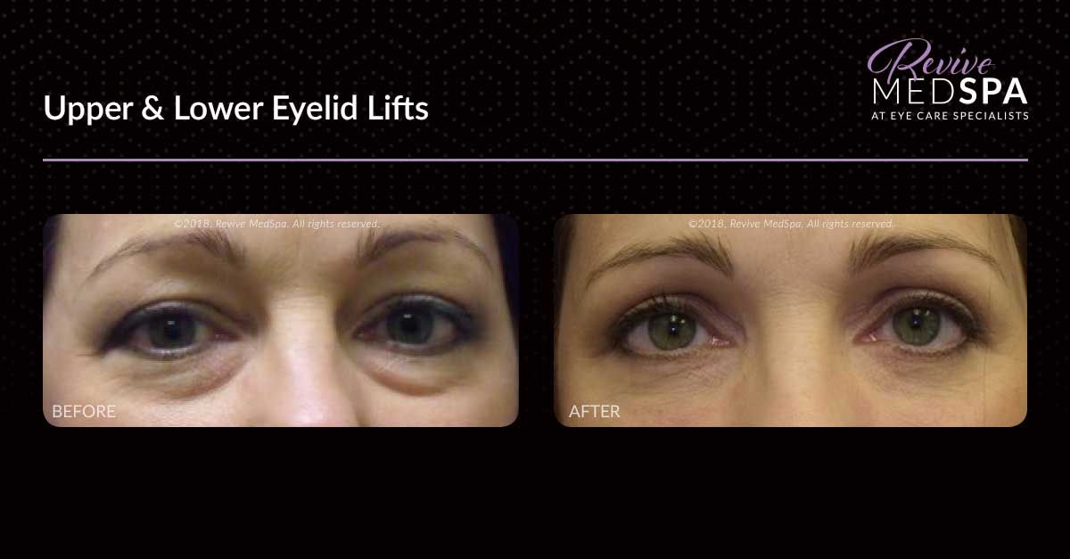Eyelid Lift