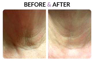 Laser Skin Resurfacing Revive Medspa